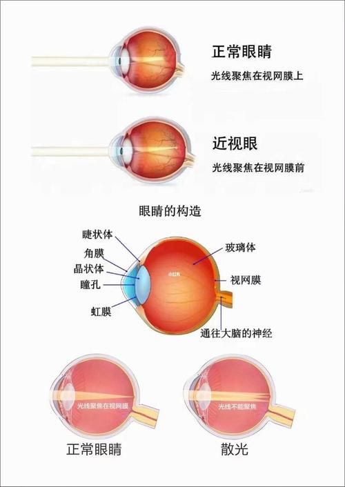 近视矫正新技术是什么(获取近视矫正方案)